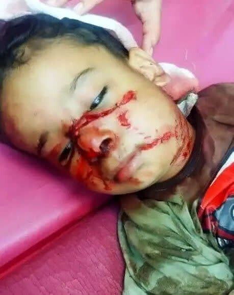 حمله سگ‌های بدون‌صاحب به کودک ۴ ساله/ عکس دلخراش